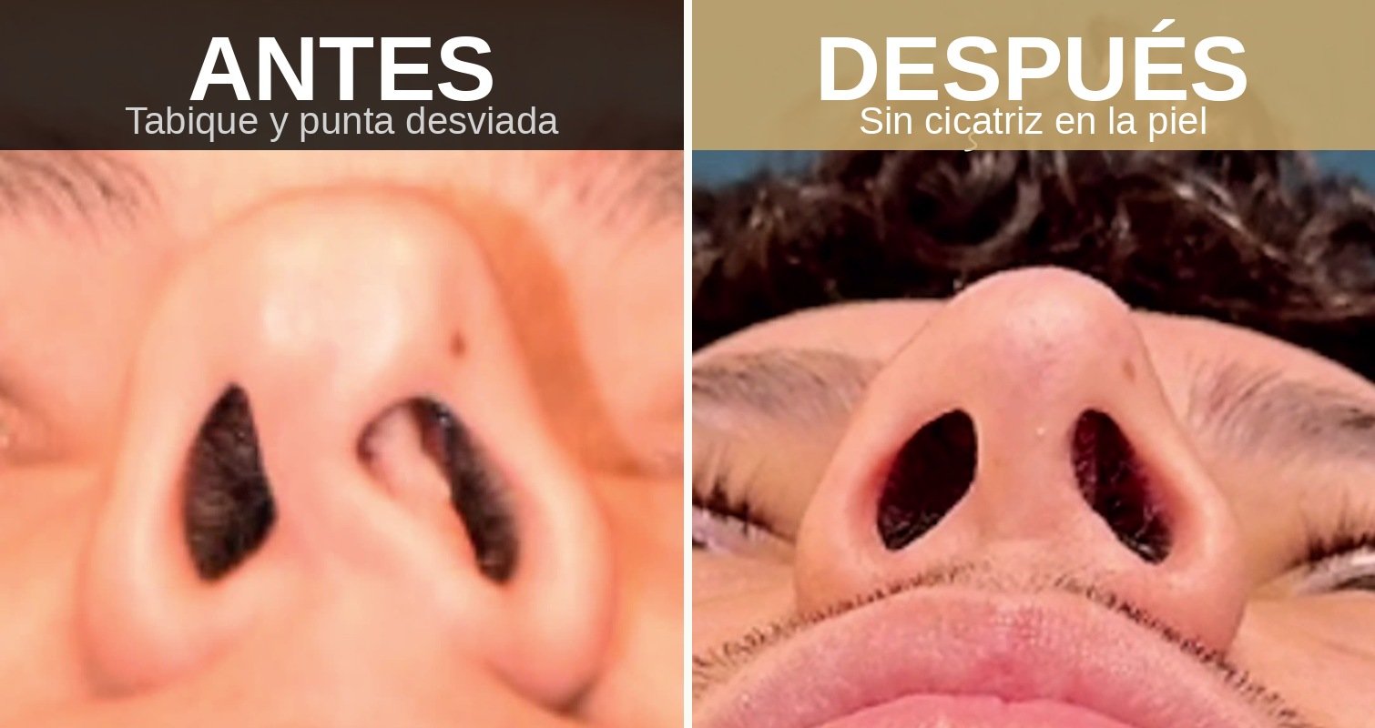 Rinoplastia abordaje cerrado antes y después