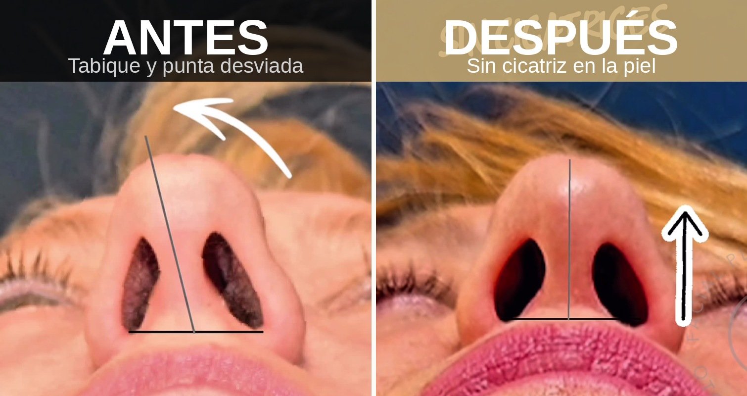 Antes y después de rinoplastia cerrada en paciente femenina · Dr. Jorge Duque Silva · Madrid