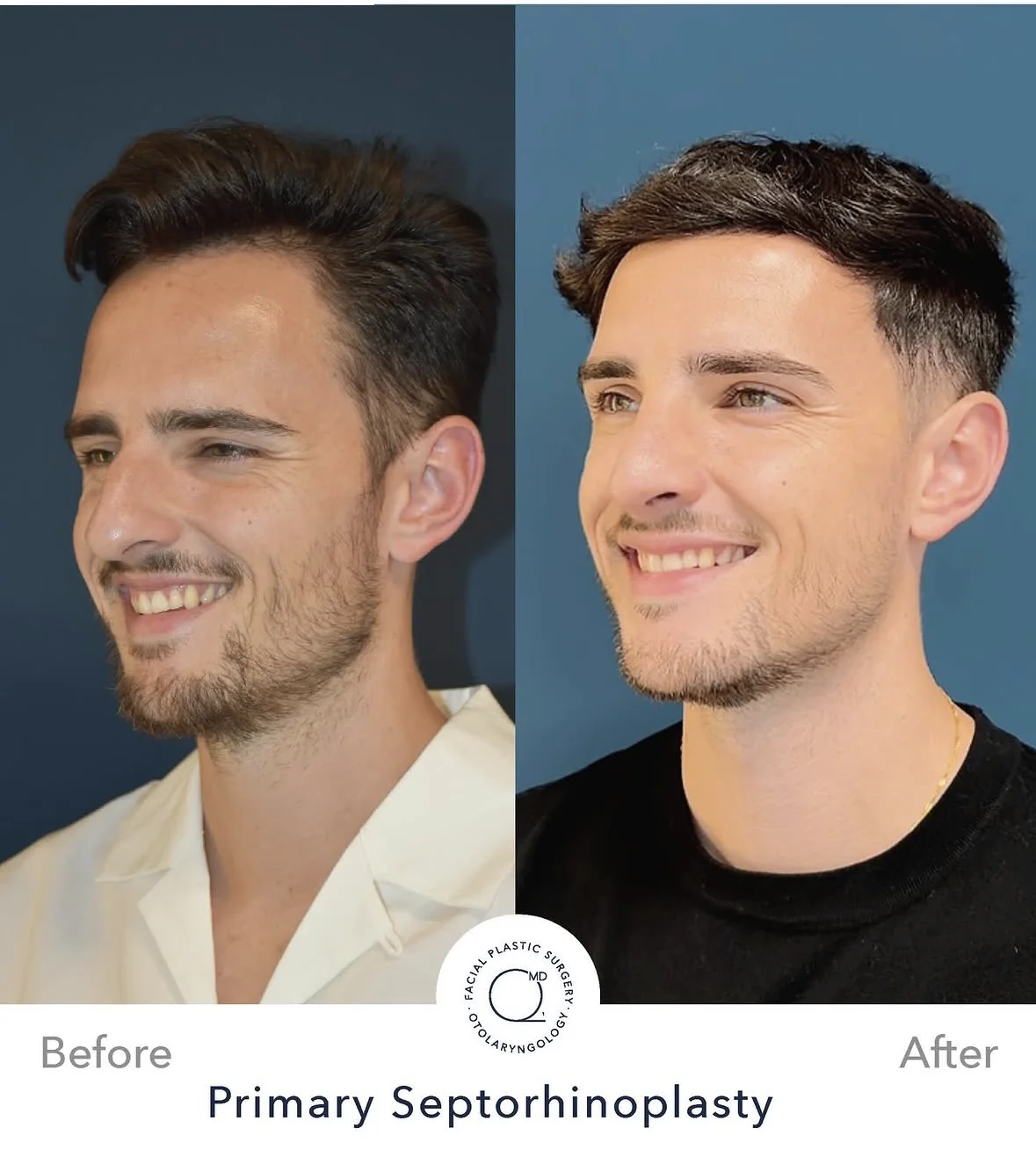 Rinoplastia masculina antes y después vista 3/4 - Dr. Jorge Duque