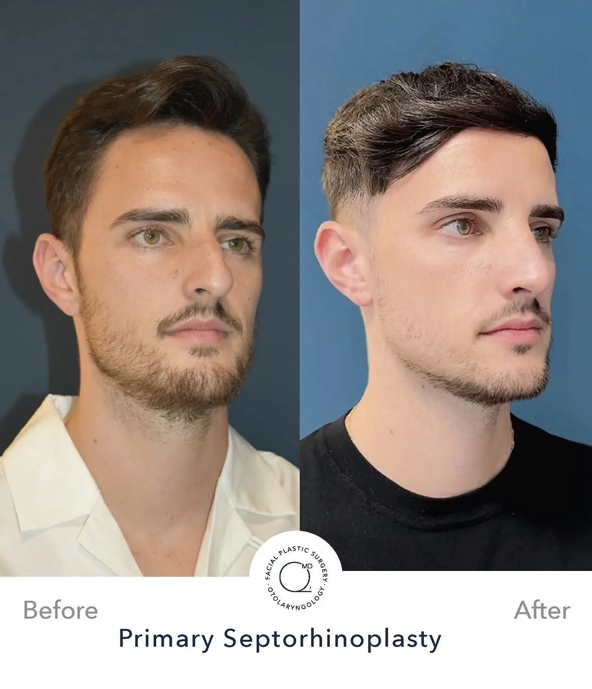 Rinoplastia masculina antes y después vista 3/4 izquierdo - Dr. Jorge Duque