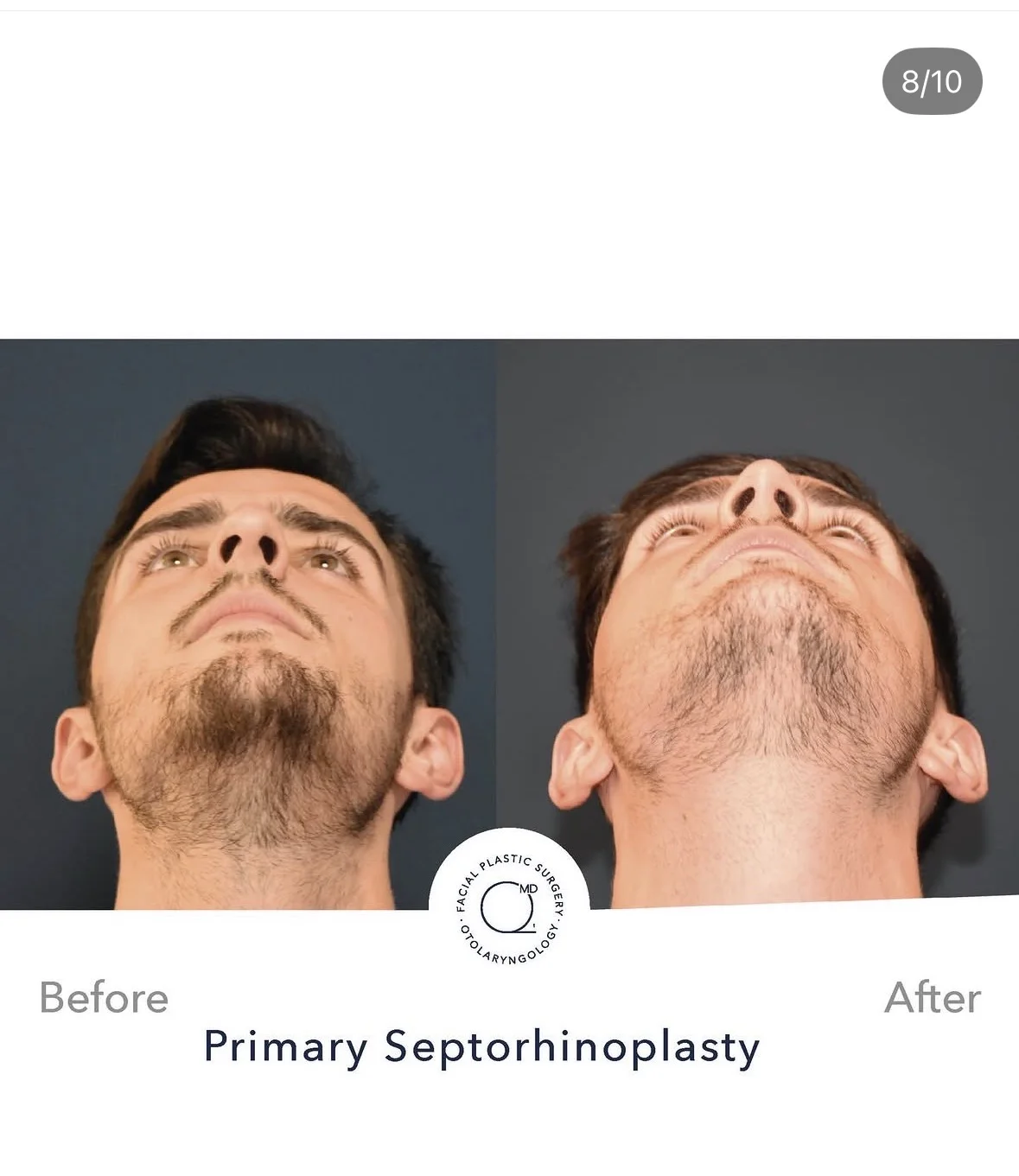 Rinoplastia masculina sin cicatriz base nasal - Dr. Jorge Duque
