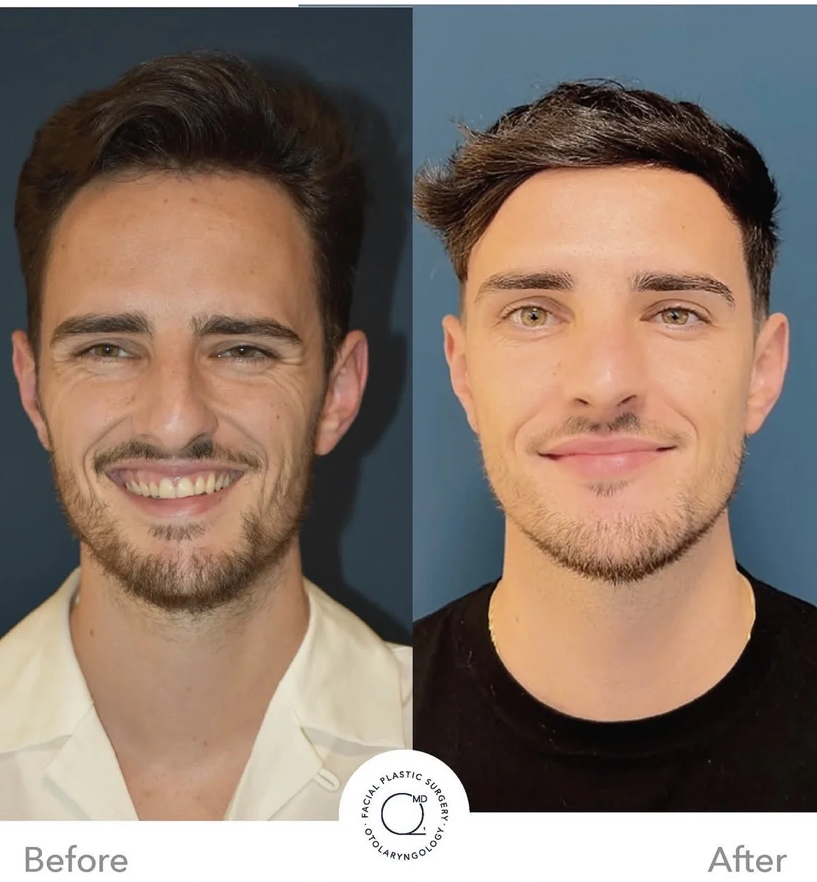 Rinoplastia masculina antes y después vista frontal - Dr. Jorge Duque
