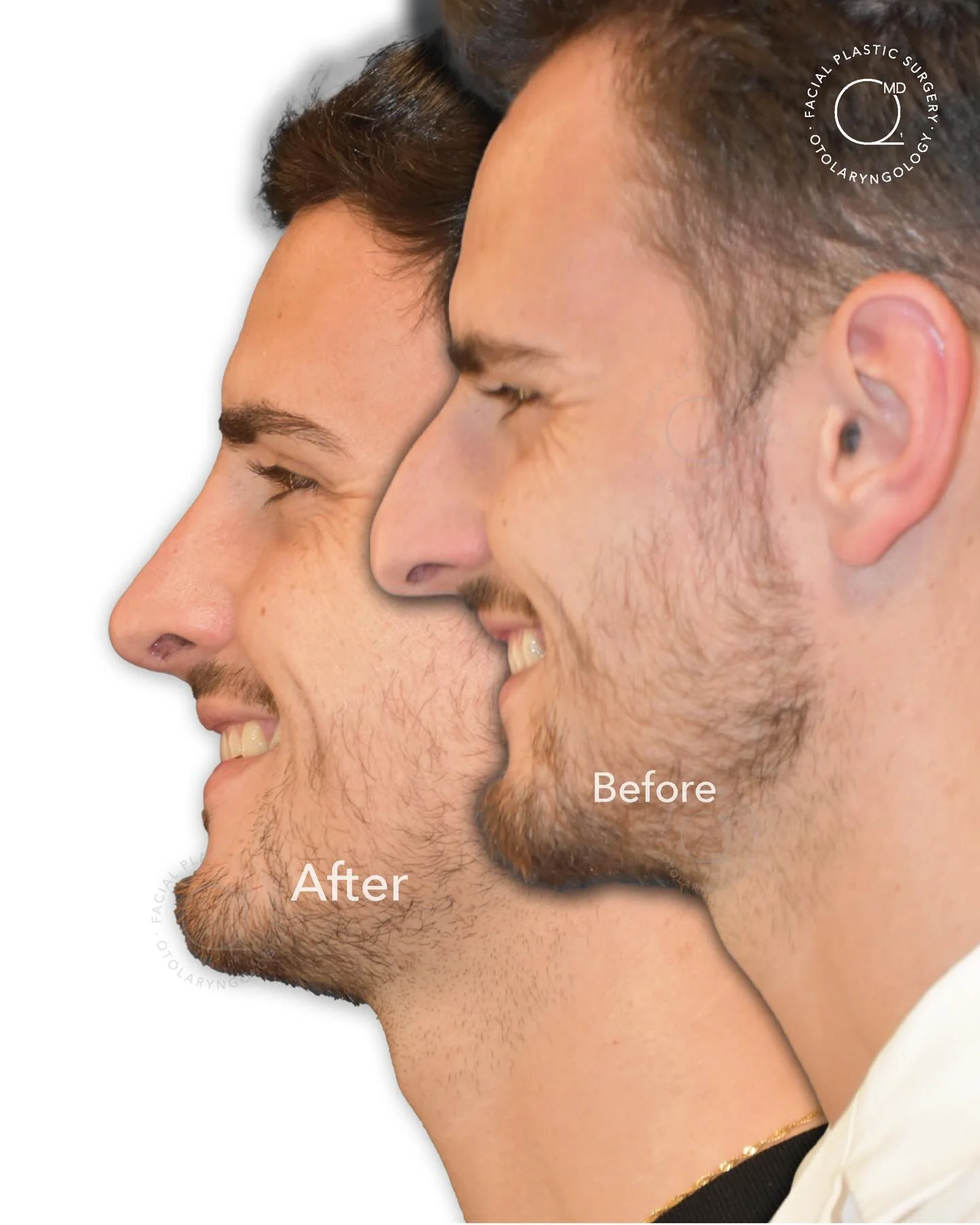Rinoplastia masculina antes y después vista de perfil - Dr. Jorge Duque