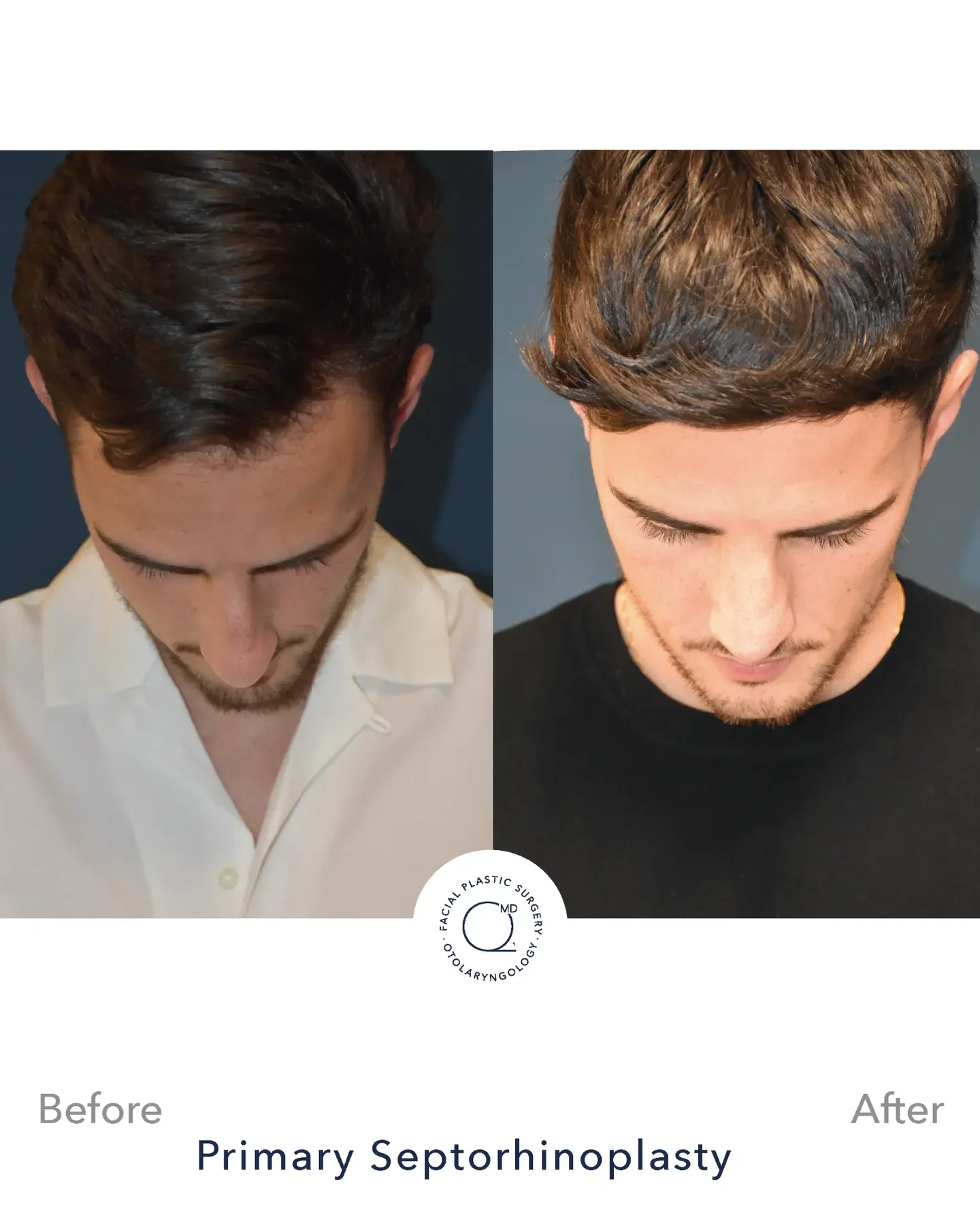 Rinoplastia masculina vista superior - Dr. Jorge Duque
