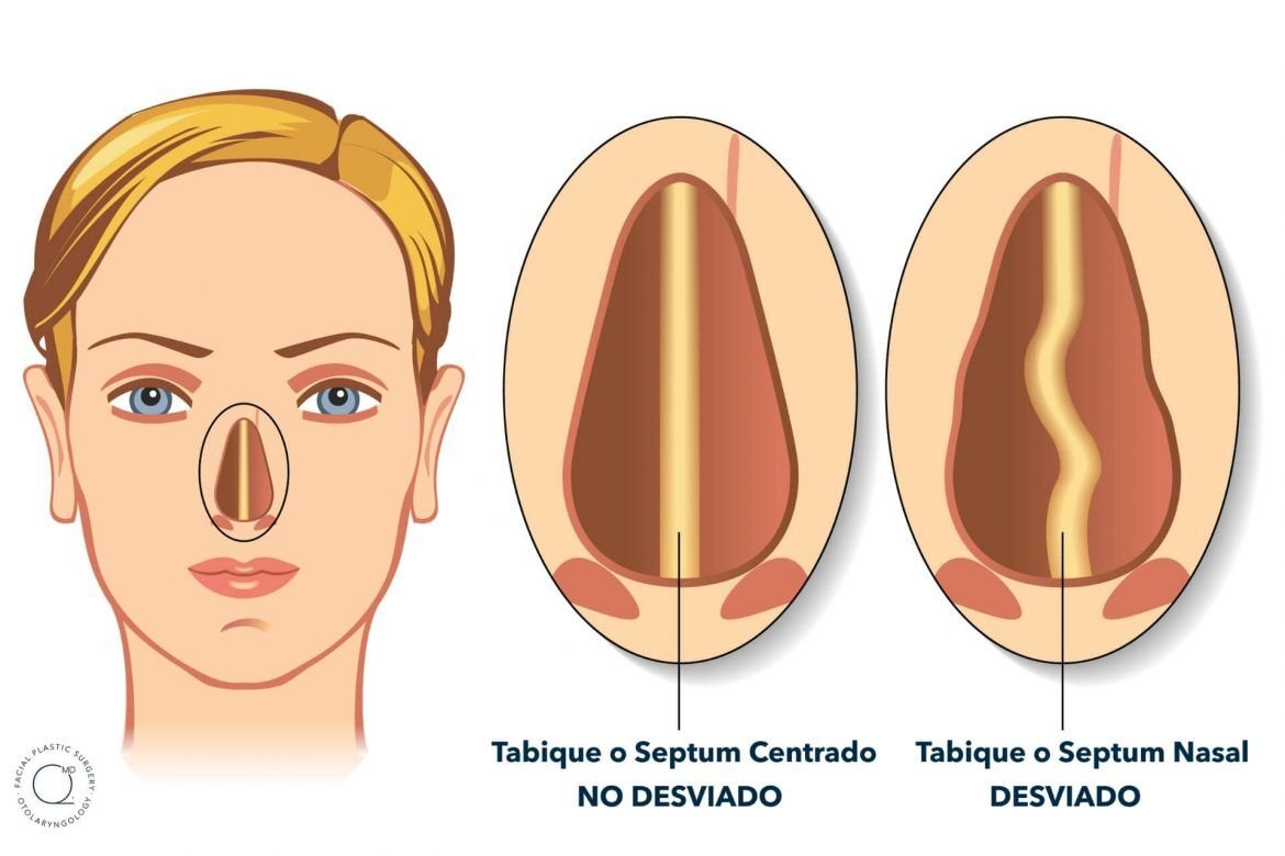Ilustración tabique desviado y no desviado - Septorrinoplastia Dr. Jorge Duque Silva